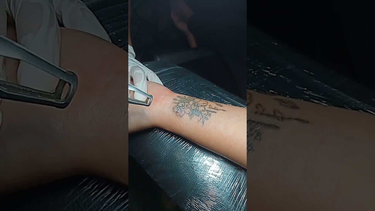 Hapus Tato Surabaya Surabaya