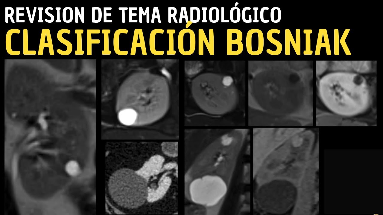Clasificación Bosniak: Guía para clasificar quistes renales
