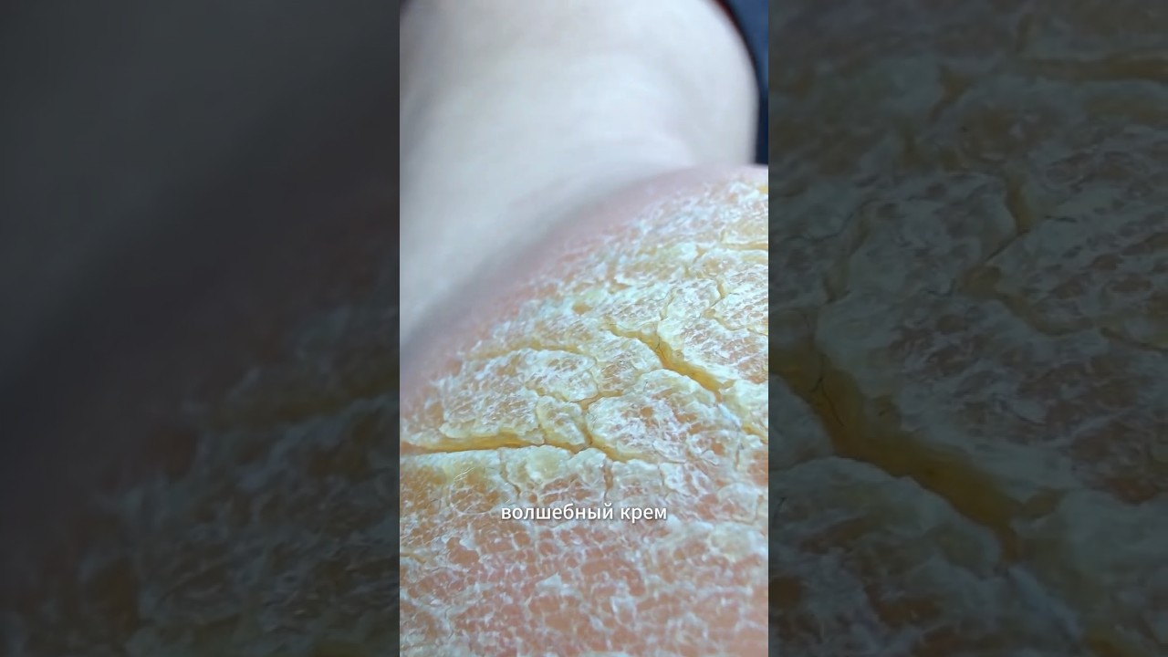 MAGIC cream for cracks