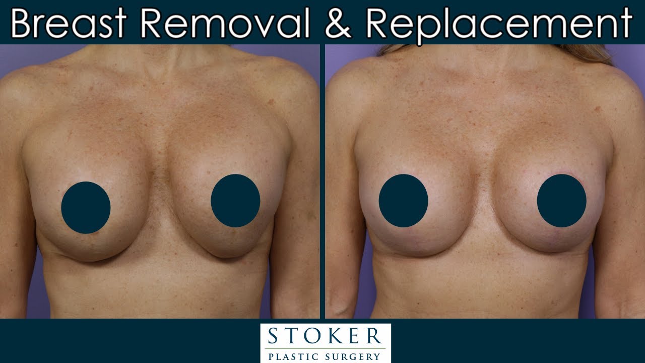 Revision Breast Implants Los Angeles: Top Plastic Surgeon on Revising for Smaller Implants & Lift