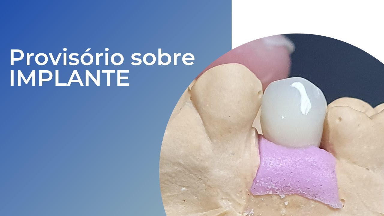 Provisório Sobre Implante