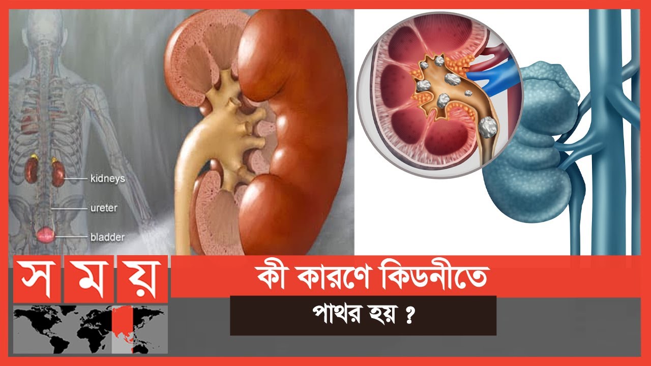 কিডনীতে পাথর হলে কী করণীয় ? | Kidney Stone | Boddi Bari | Somoy TV