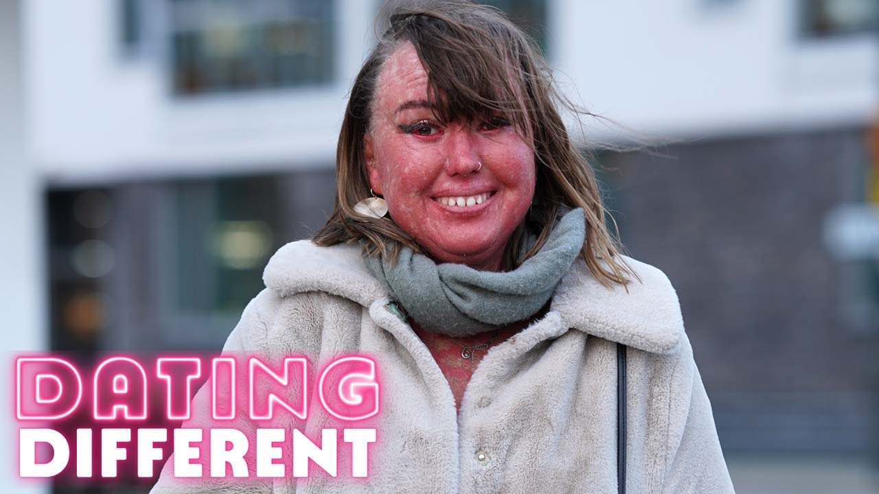 Will My Blind Date Look Past My Skin Condition? | DATING DIFFERENT
