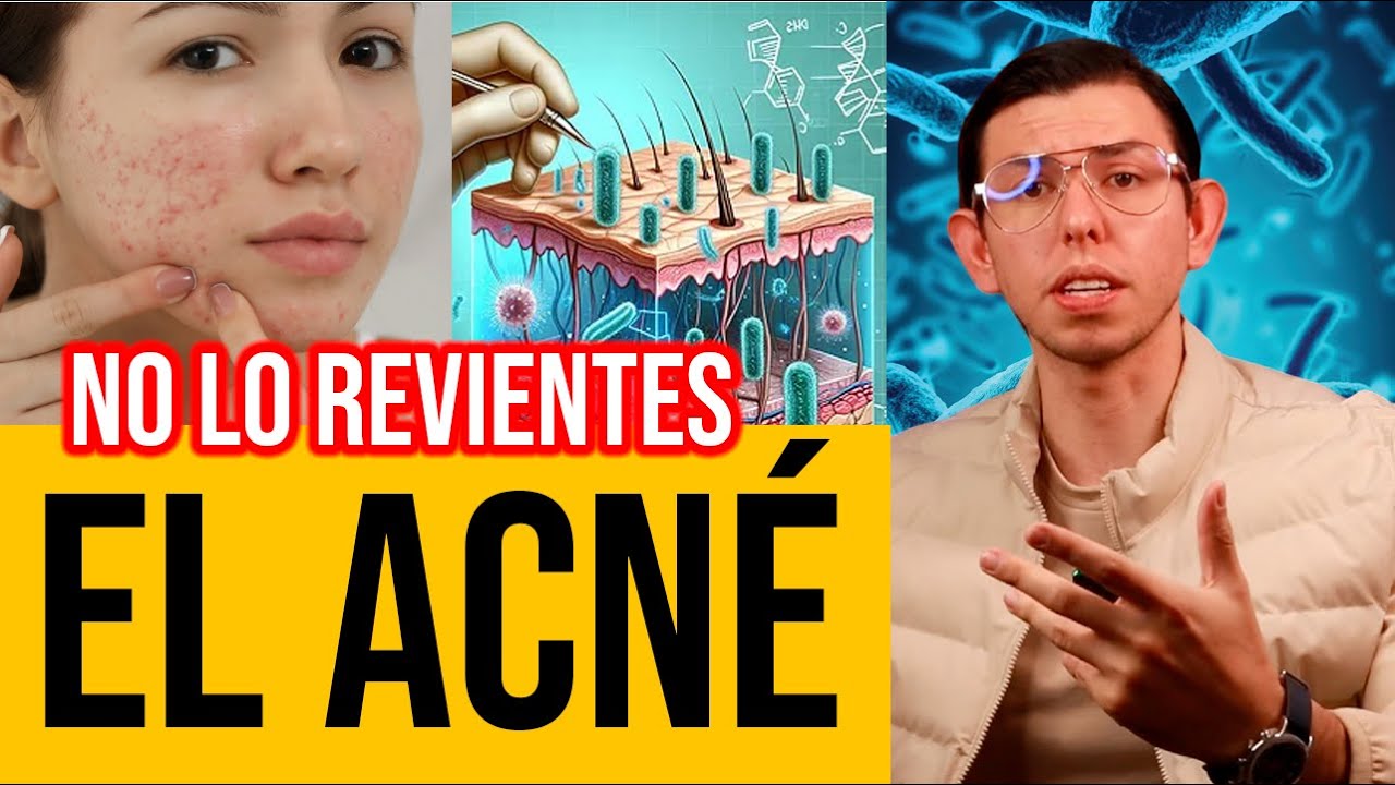 TODO sobre el ACNÉ!! (No lo revientes) | DrPoloGuerrero