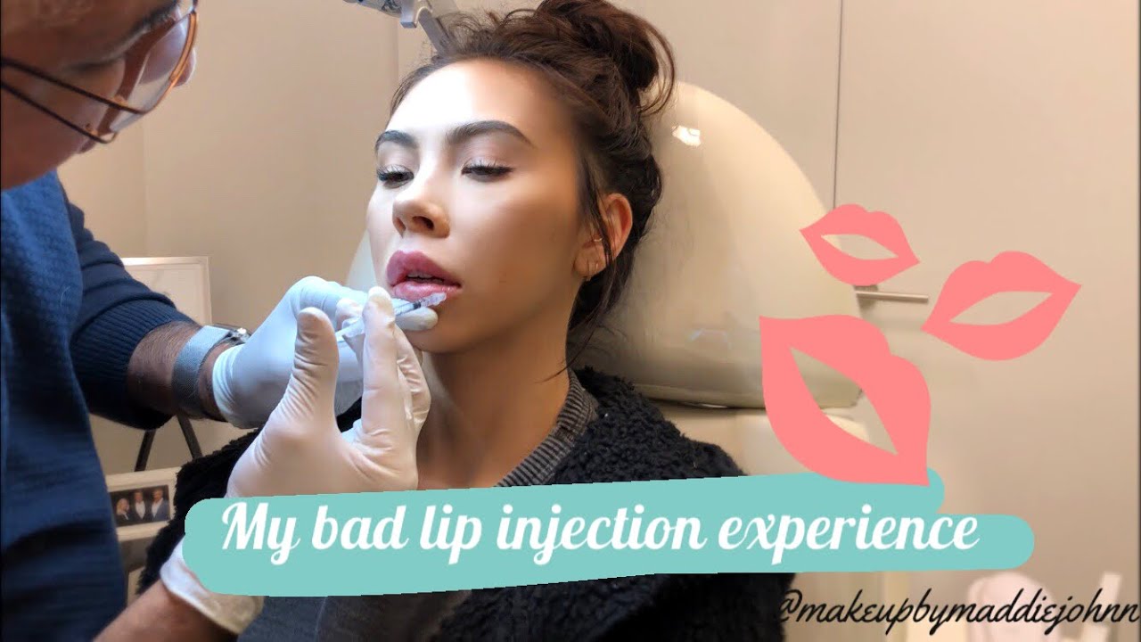 MY BAD LIP INJECTION EXPERIENCE & THE PROCESS OF FIXING THEM. (PART I) Ft. Dr. Kumar