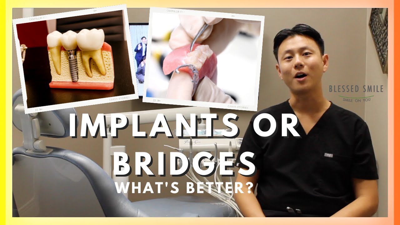 DENTAL IMPLANT vs. BRIDGE to replace missing teeth | Dentist Reviews