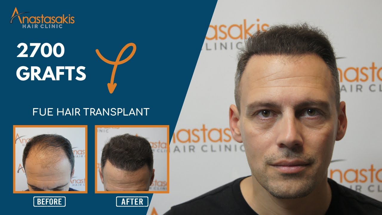 Hair Restoration Result- stage 5: Dimitris' 10-Month Transformation! 🌟✨ Case #253b