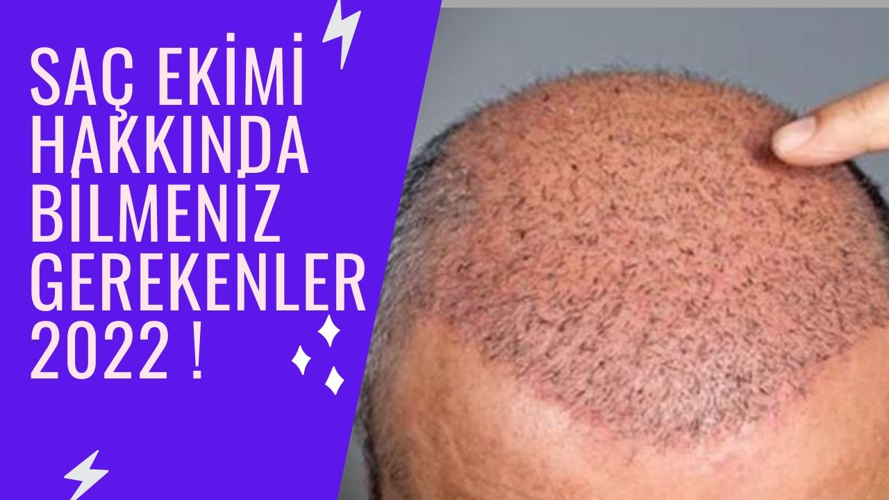Saç Ekimi Hakkında Bilmeniz Gerekenler 2022 II Dr.Fatih DAĞDELEN
