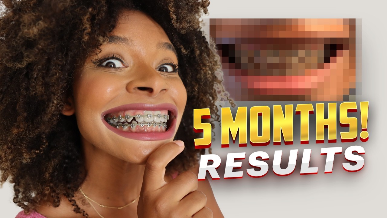 How My Smile Has Changed in 5 Months with Orthodontic Braces