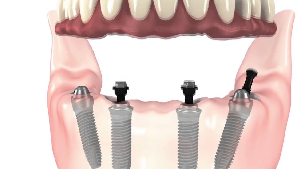 All On İmplant Sistemi - 4'ü Bir Yerde İmplantlar - Dr. Namık Kemal Ayhan