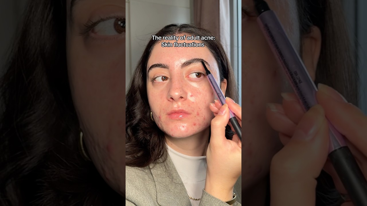 The reality of dealing with hormonal acne..😓❤️ #acnepositivity #skincare #hormonalacne #selflove