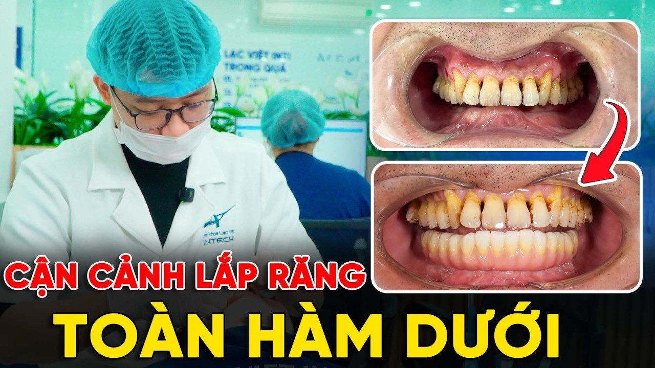 Toàn hàm trên Implant | giải pháp tối ưu nhất cho người mất răng toàn hàm