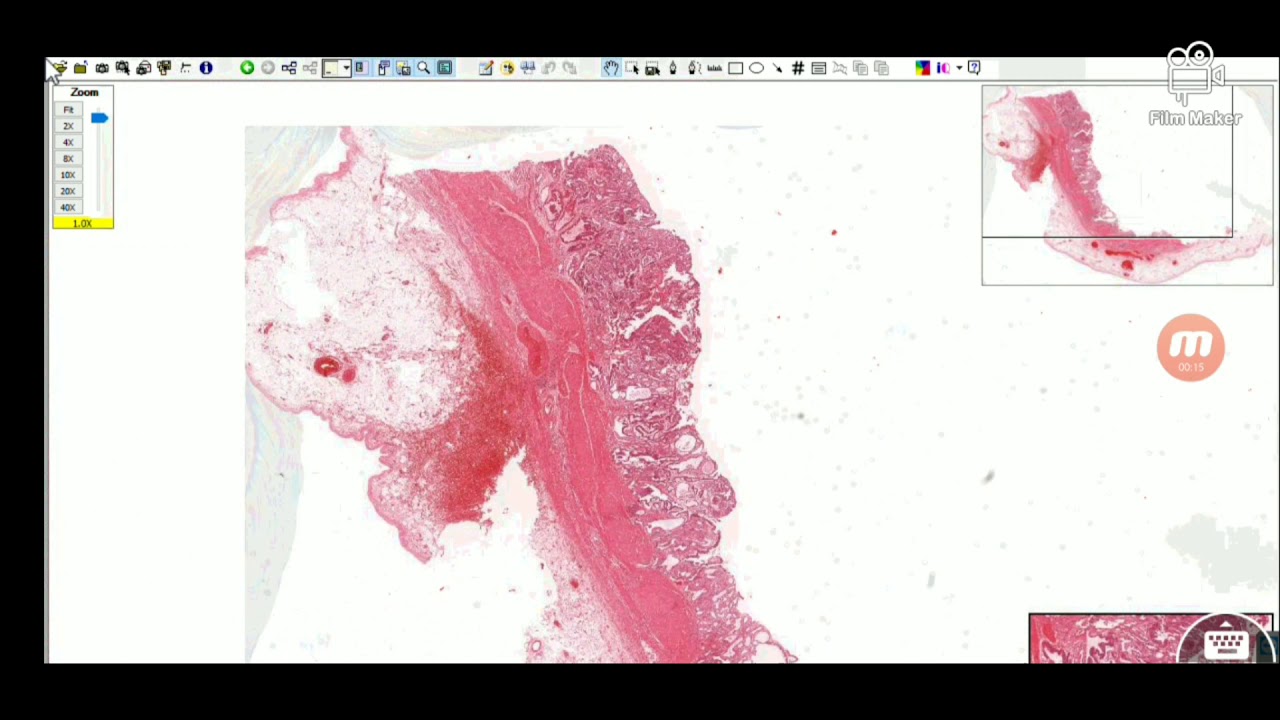 Cholecystitis - Histopathology slides