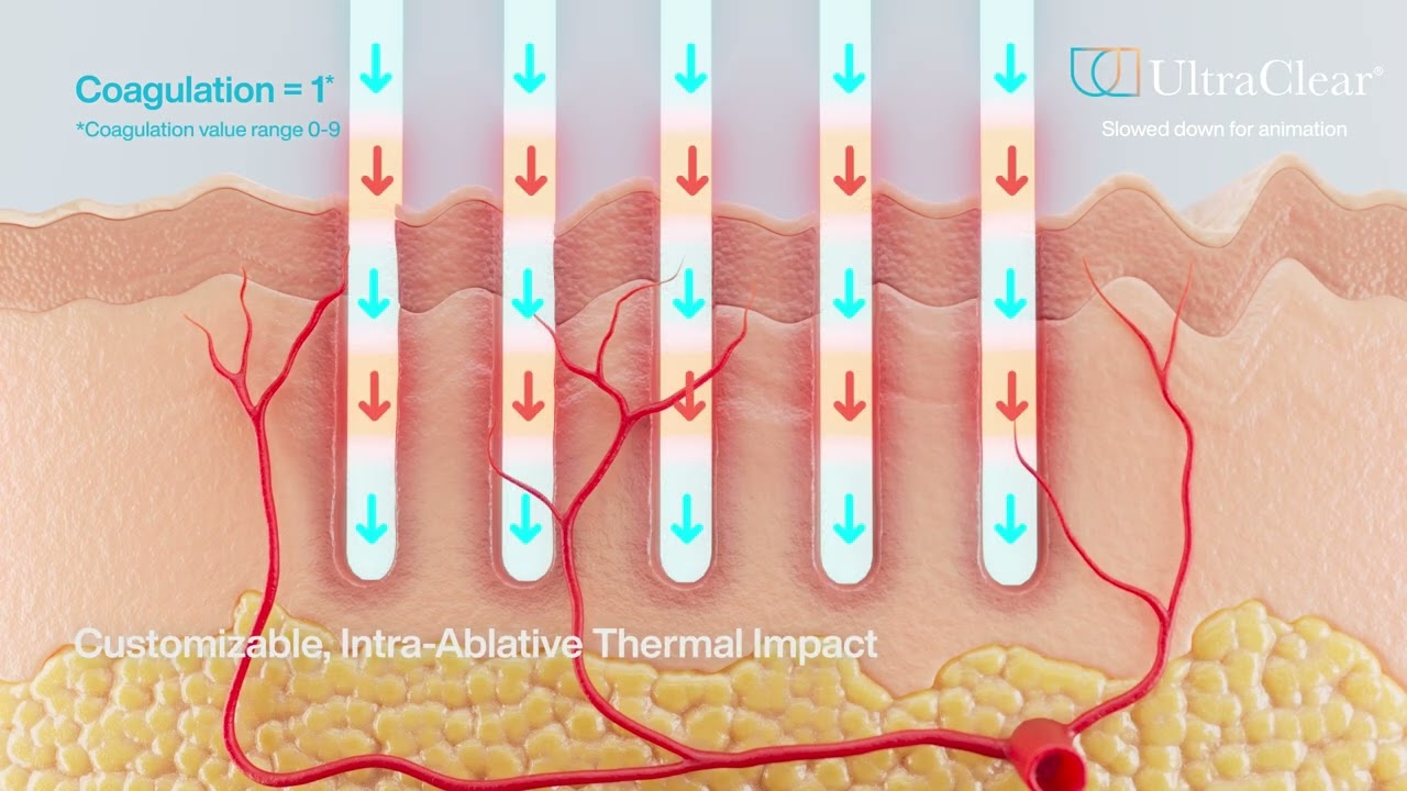 Introducing UltraClear's 3DIntelliPulse® Technology