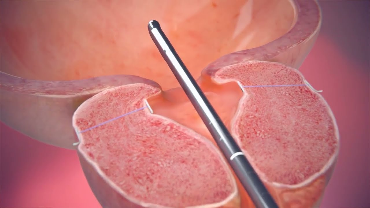 The UroLift&reg; System Procedural Video