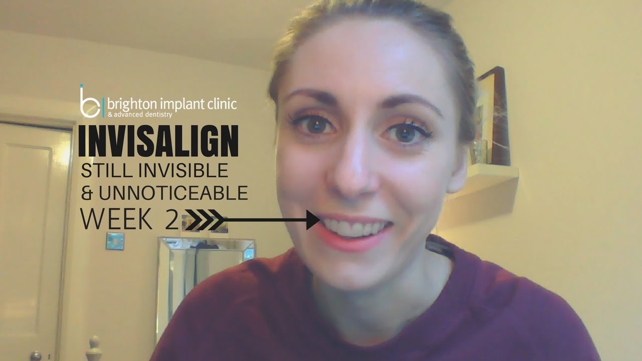 Invisalign Treatment Vlog After 2 weeks