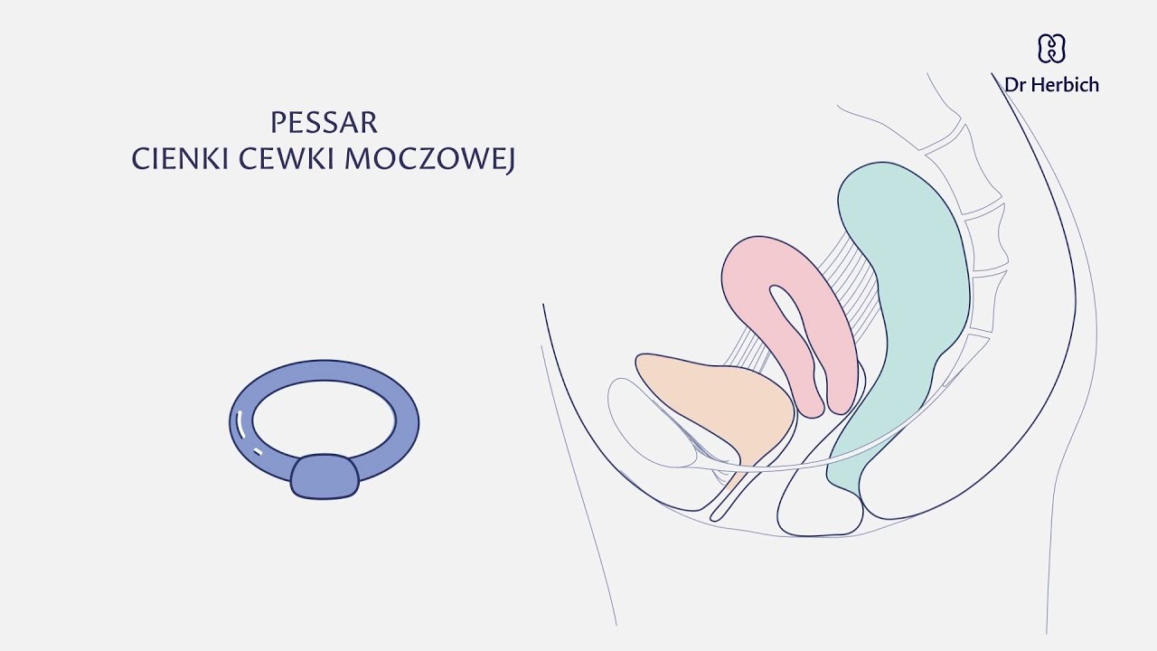 Jak działa pessar cienki cewki moczowej przy wyśiłkowym nietrzymaniu moczu?