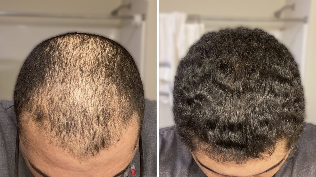 Su Pelo Vuelve De La Tumba En 3 Meses