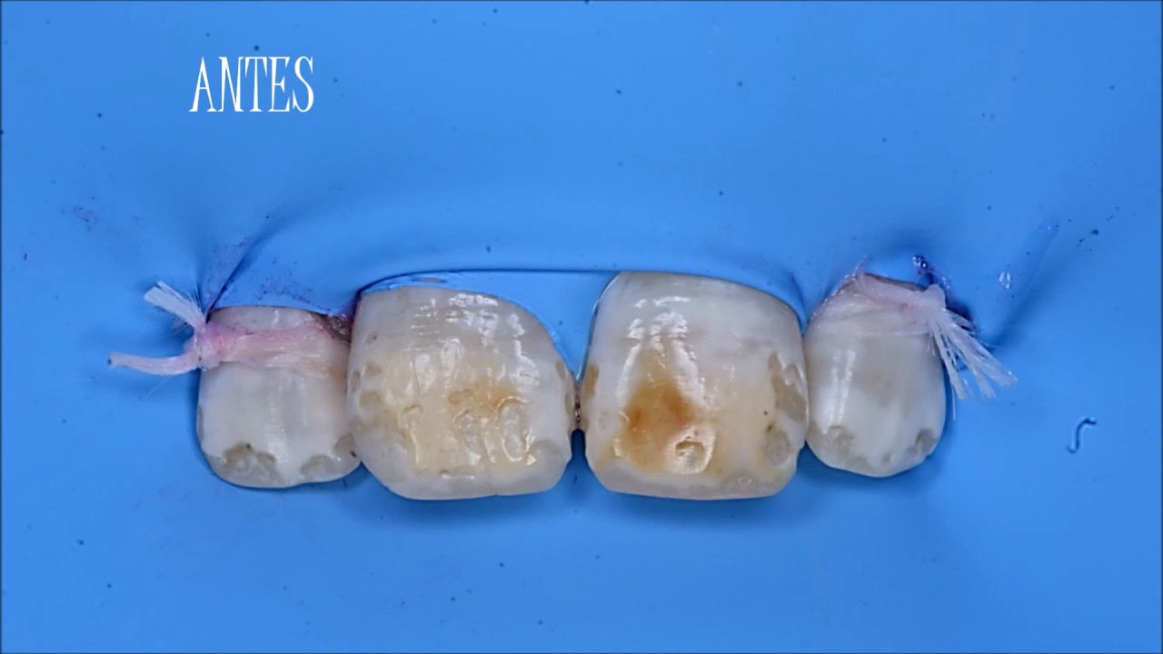 Casos de Fluorosis, por Antivet