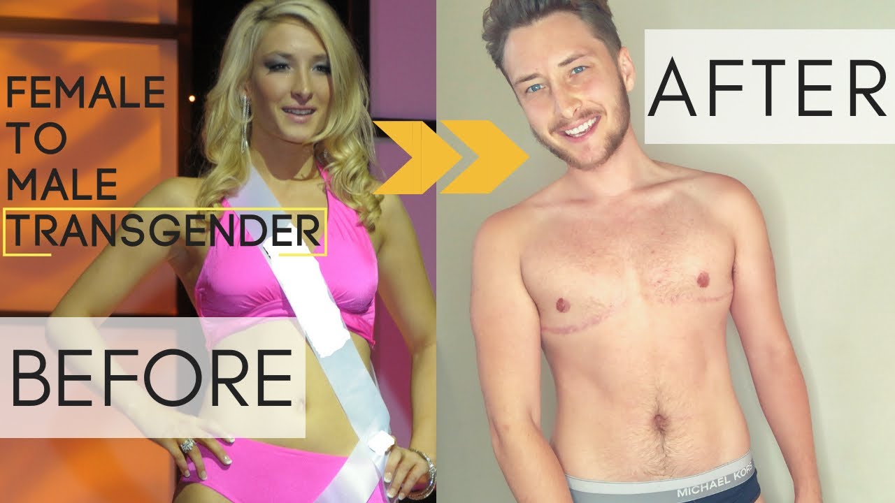 FEMALE TO MALE TRANSGENDER FTM TRANSITON 6.5 YEARS