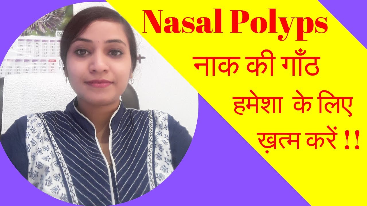 nasal polyps treatment | homeopathy for nasal polyps | nasal polyps homeopathic medicines | video