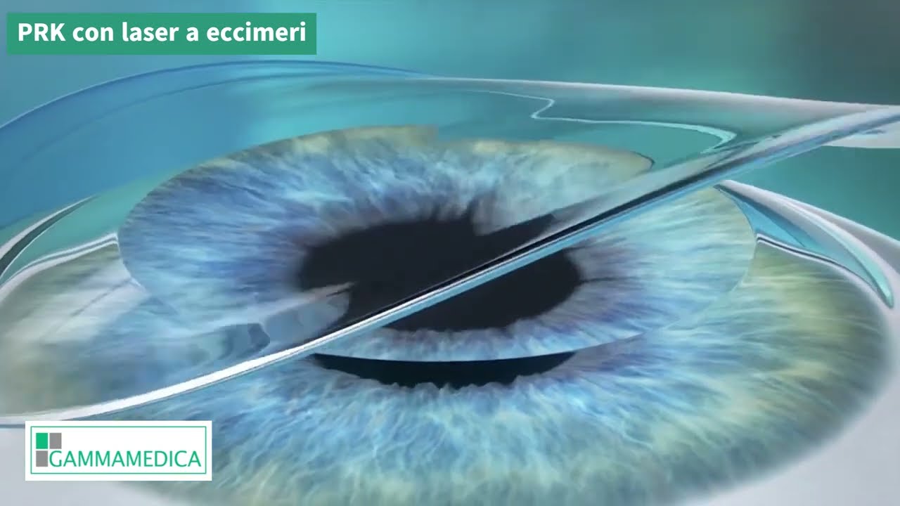 Gamma Medica - Intervento di PRK con laser a eccimeri