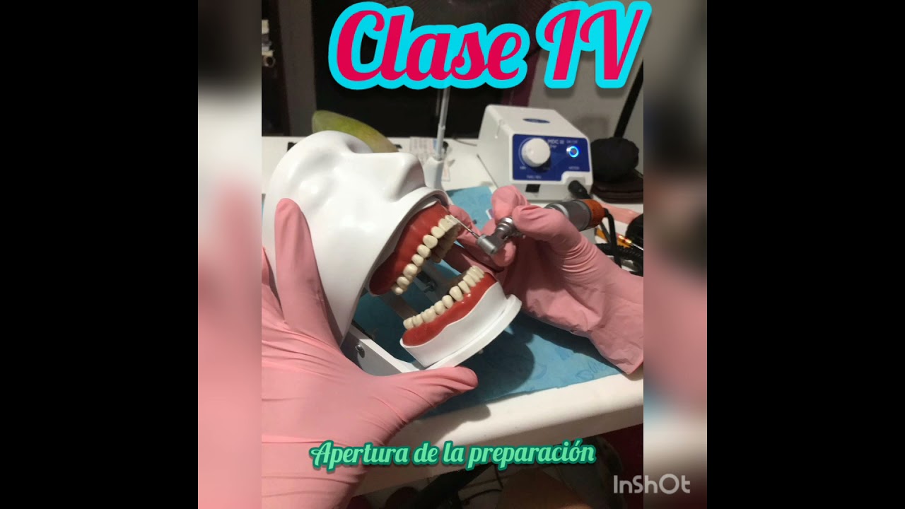 Dise&ntilde;o y Preparaci&oacute;n Clase IV (Tipodonto o Carodonto)