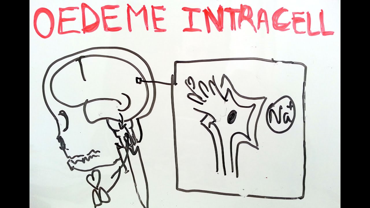 SmartN'Easy - Physiopathologie de l'oedème intracellulaire - Dr Astuce