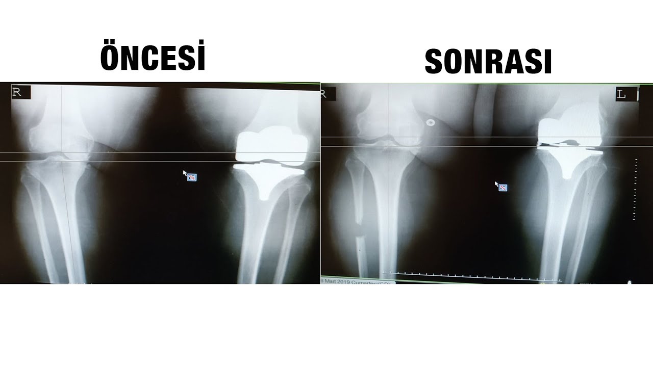 Diz Yük Ayarı Ameliyatı Sonrası İyileşme süreci
