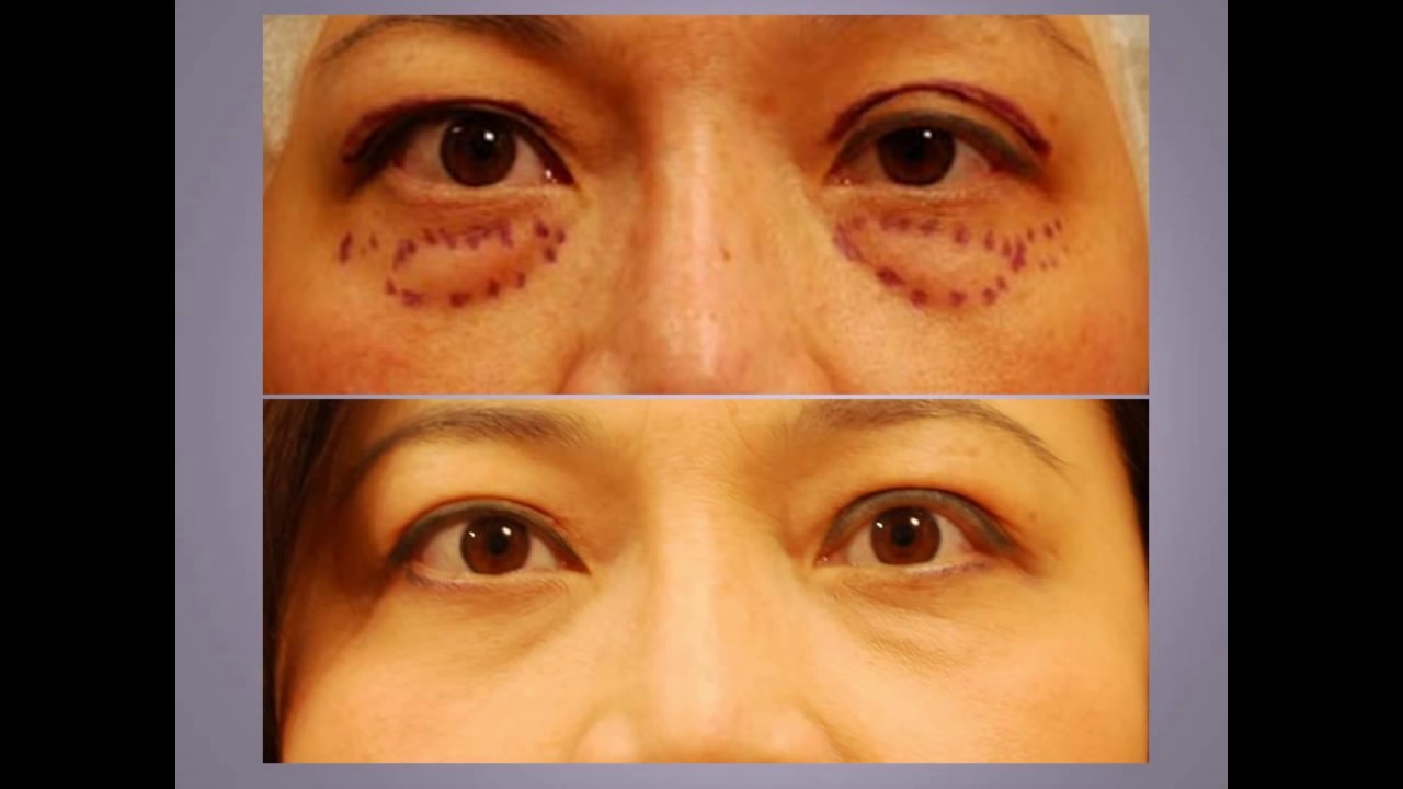 #ChaseLayMD Ptosis Droopy Eyelid Surgery