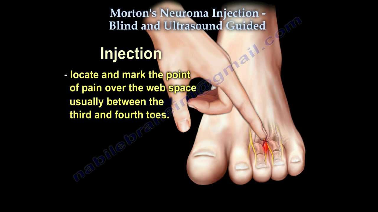 Morton's Neuroma Injection - Everything You Need To Know - Dr. Nabil Ebraheim
