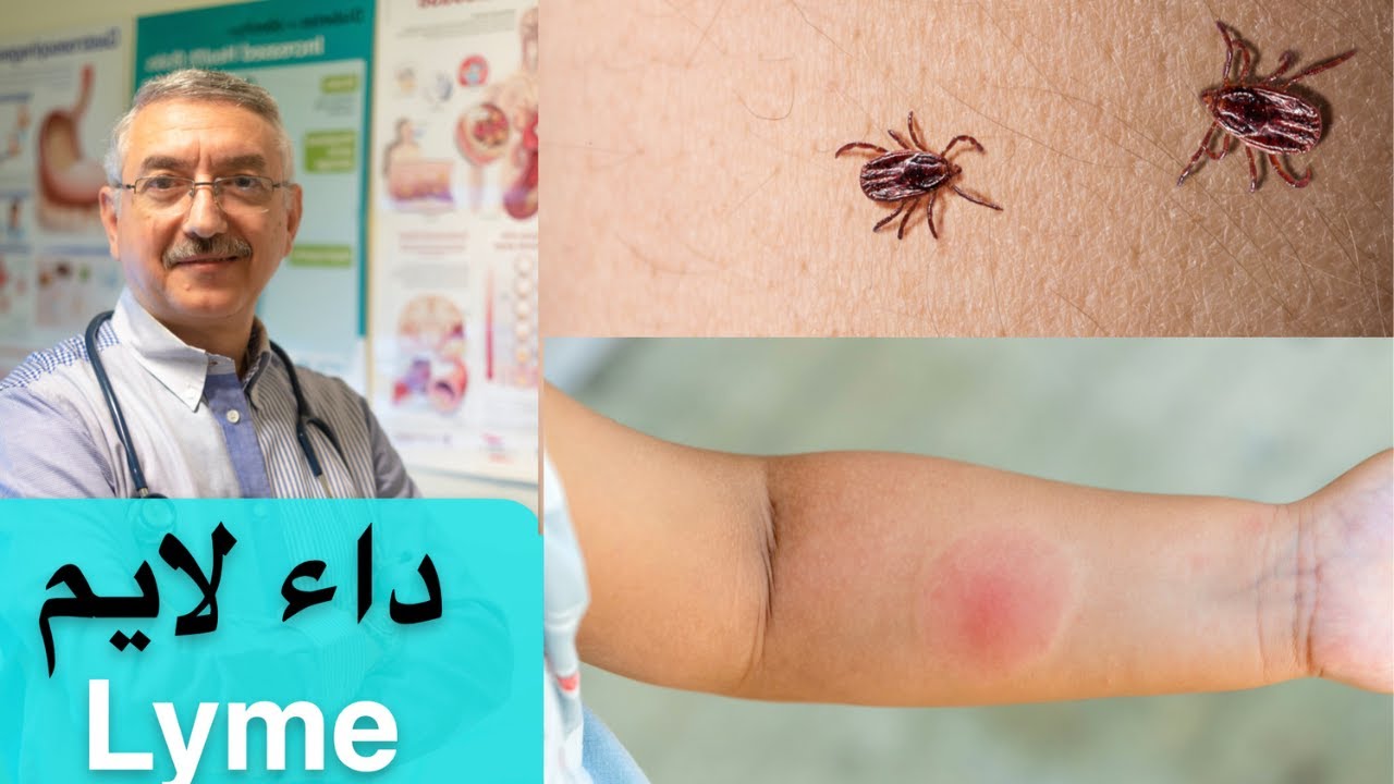 مرض لايم: لدغة حشرة خطيرة