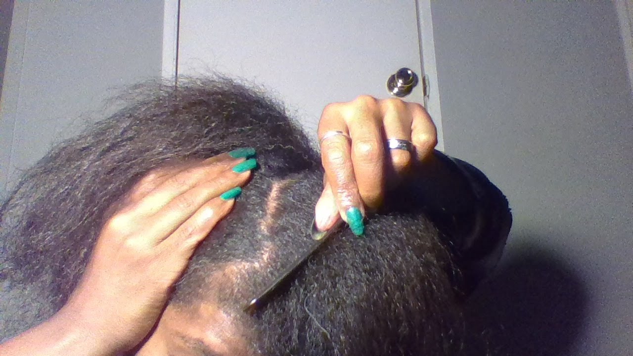DANDRUFF SCRATCHING / ITCHY DRY SCALP/Psoriasis