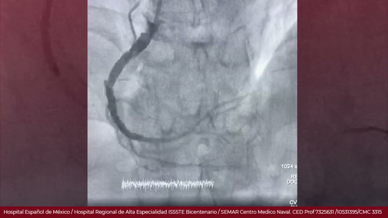Angioplastia Coronaria Derecha