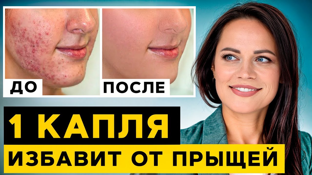 Эфирные масла ПРОТИВ АКНЕ! / Как УБРАТЬ прыщи с помощью ОДНОГО средства?