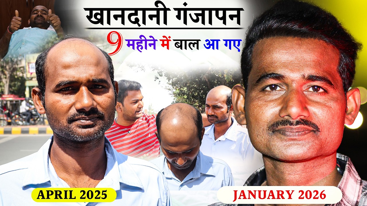 9 महीने में खानदानी गंजापन खत्म (Hair growth Result before after)