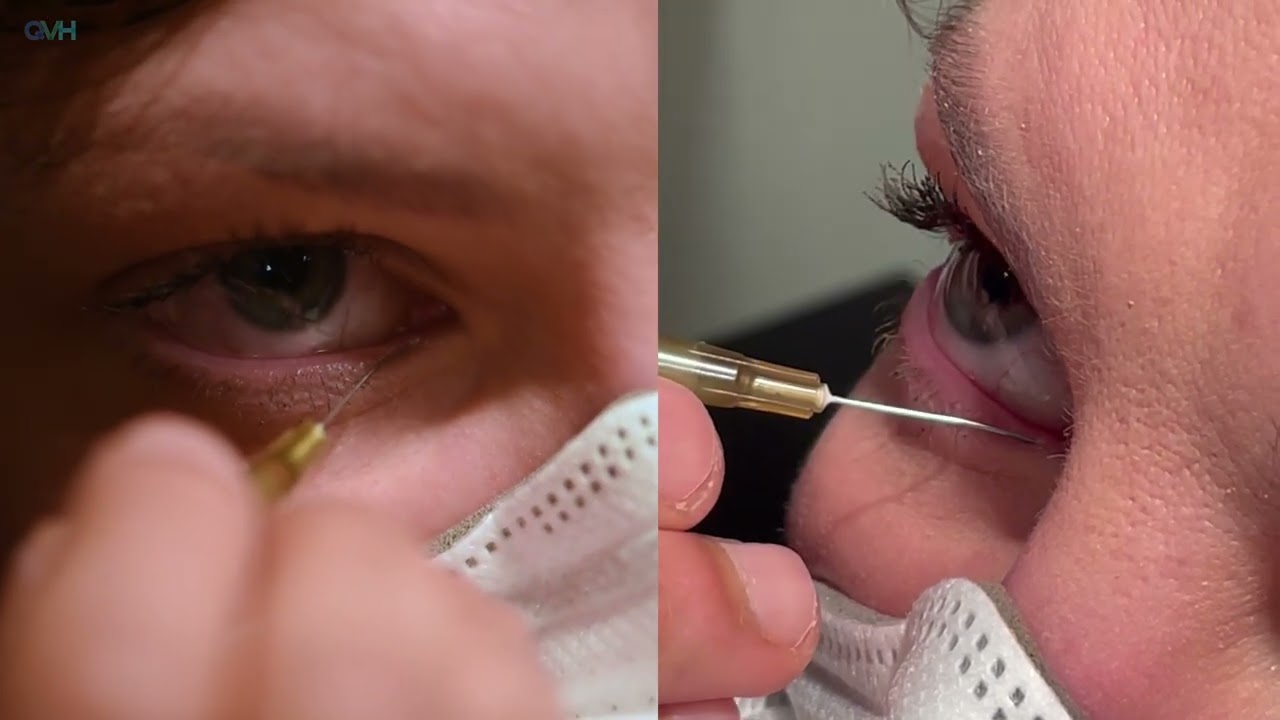 How to Perform Lacrimal Syringing and Irrigation