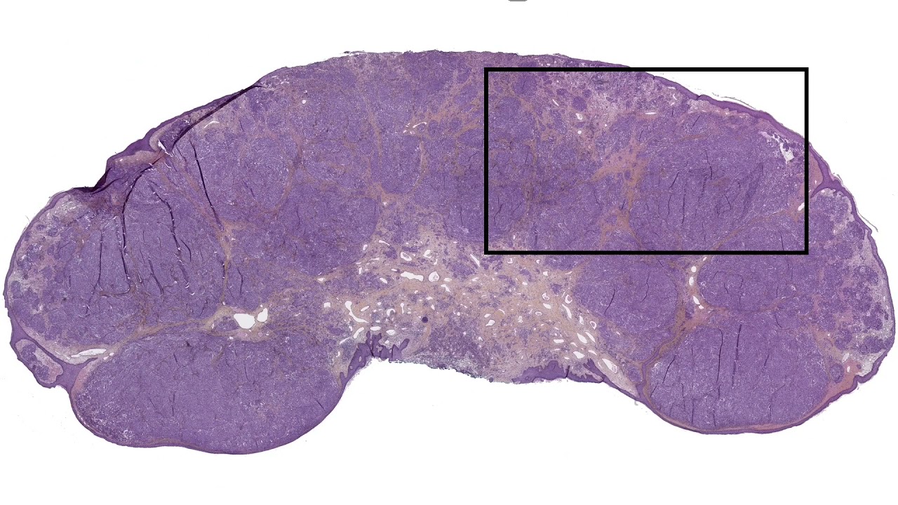 MYO5A-NTRK3 pseudo-schwannomatous Spitz nevus: morphological clues in the #NonAIpath project