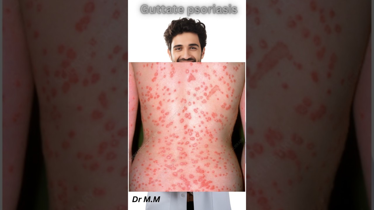 Psoriasis Types You Should Know! #Dermatology