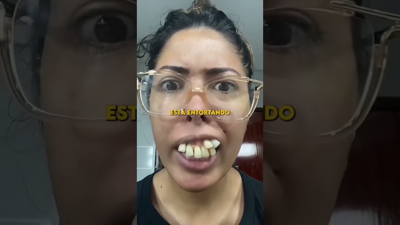 Voc&ecirc; j&aacute; enrolou pra extrair o siso por medo? #dentes #siso #saude