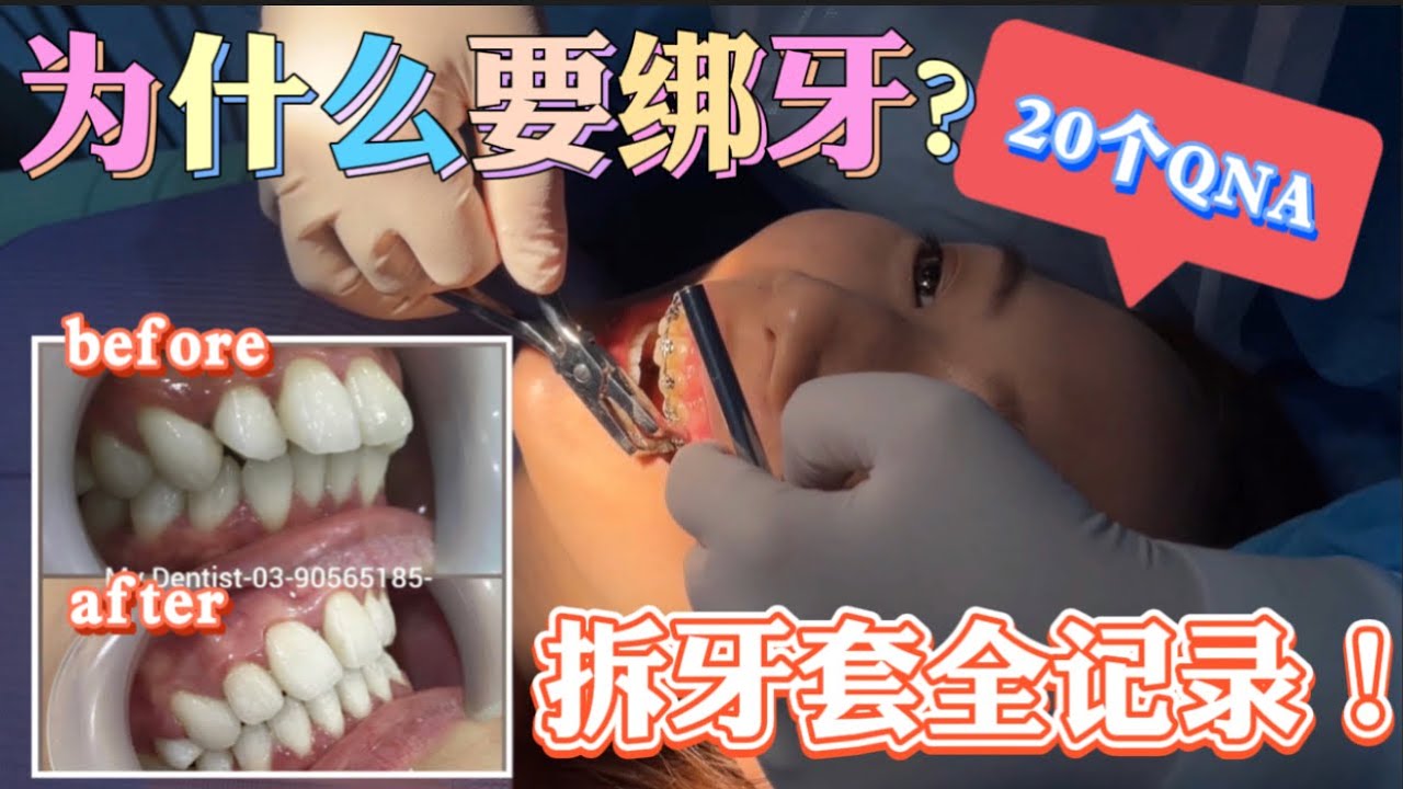 绑牙日记｜为什么要绑牙？直接分享20个绑牙的心路历程！绑牙绝对不后悔！