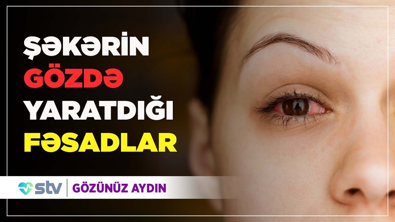 Şəkər xəstələrində göz problemləri  (05.08.2020)