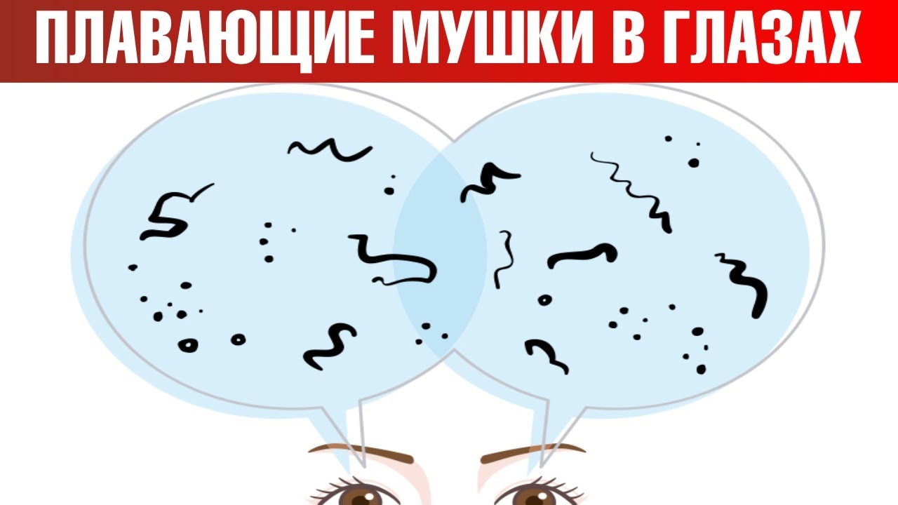 Как избавиться от мушек в глазах? Мушки перед глазами: причины🧐
