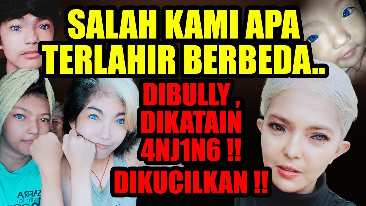 TERLAHIR DENGAN GEN LANGKA WAADENBURG 