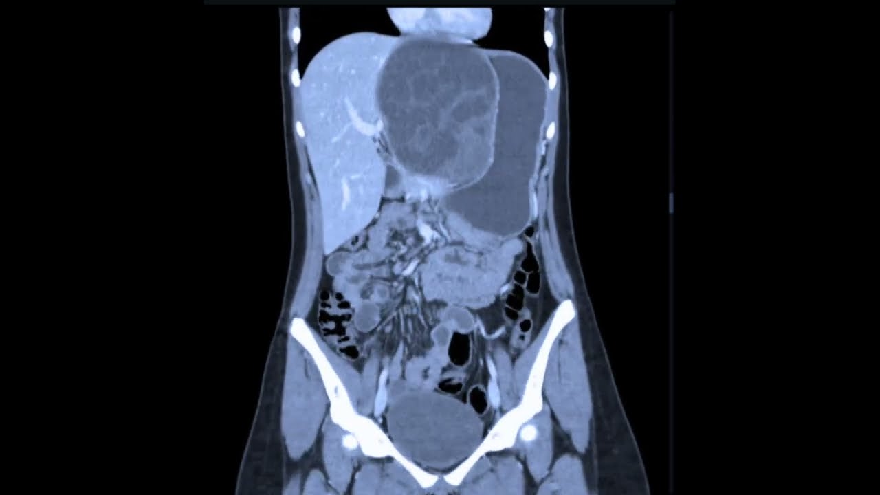 Wha is Hepatic Hydatid Cyst | Causes, Symptoms, Diagnosis & Treatment Explained