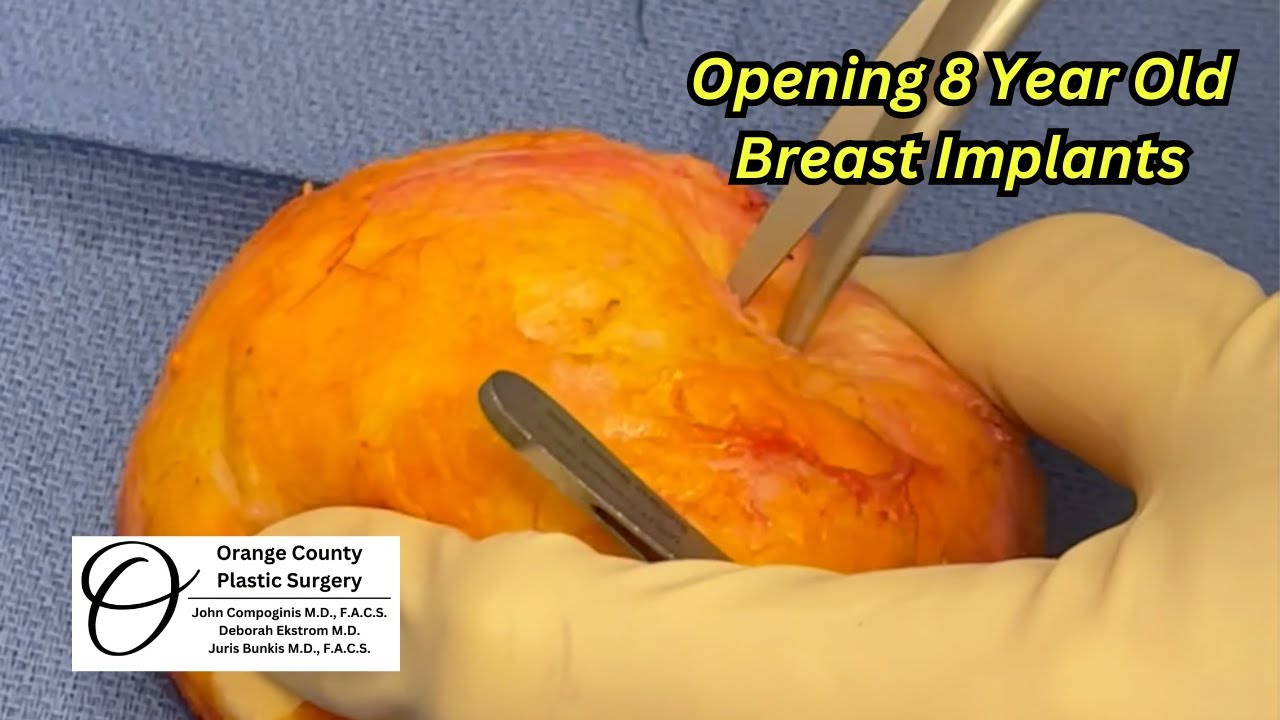 Opening Breast Implants | Orange County Plastic Surgery #plasticsurgeon #breastaugmentationsurgery