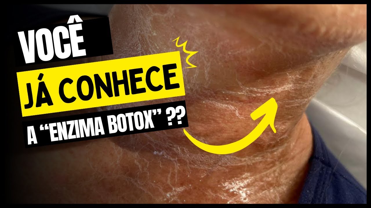 Afinal o que &eacute; a Enzima Botox? Passo a passo desse procedimento que t&aacute; dando o que falar