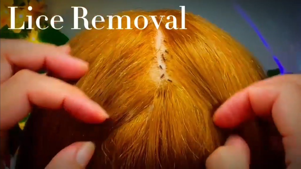 Get Tingly With Asmr Lice Removal Scalp Check & Popping Sounds 😌💆&zwj;♂️💥