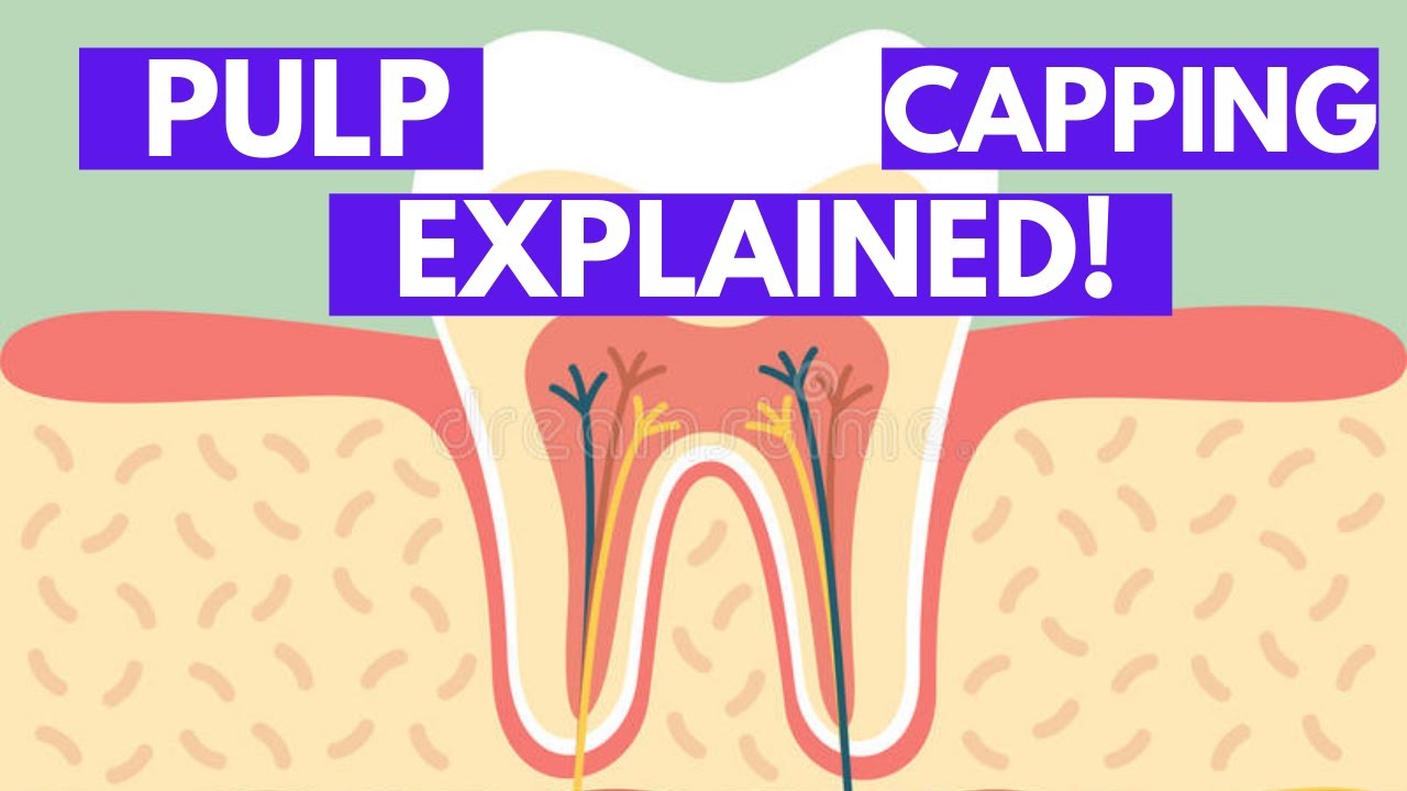 Direct and Indirect Pulp Capping (Vital Pulp Therapy)  - Explained in Detail