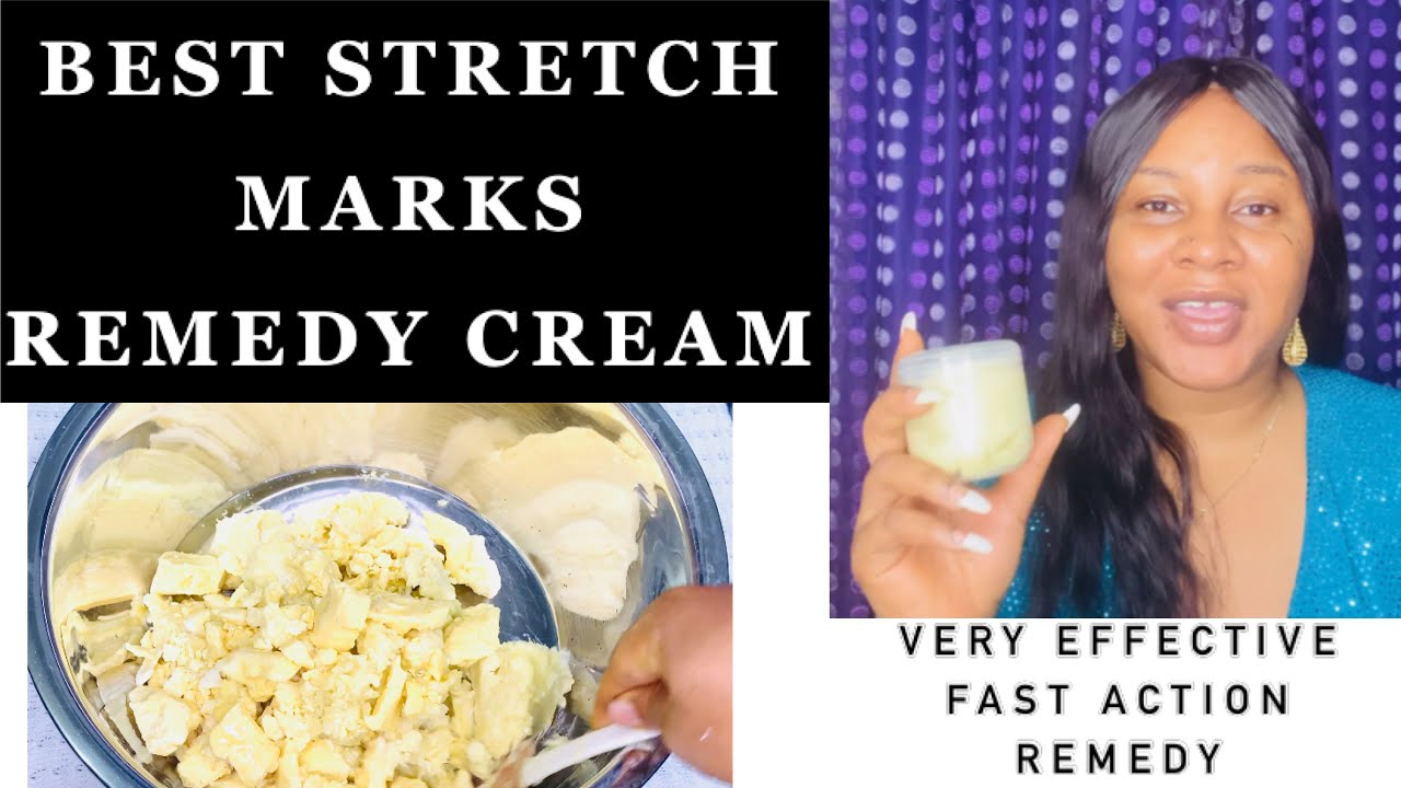How to make a stretch Marks cream | BEST STRETCH MARKS REMEDY